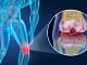 Biomagnetism-Arthrities-5